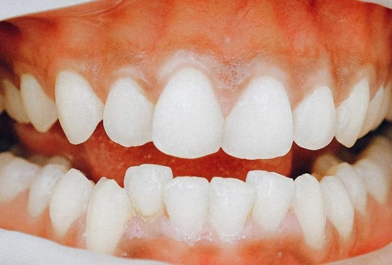 علت نامرتبی دندان با بالا رفتن سن