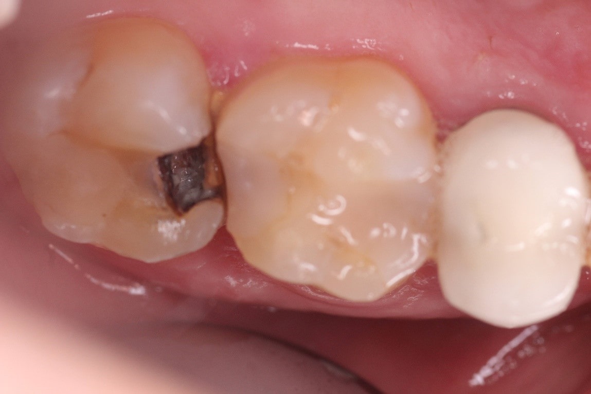 پوسیدگی دندان درمان شده