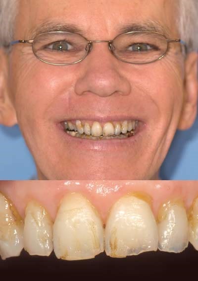 پیشگیری از از دست دادن دندان در بیماران سرطانی