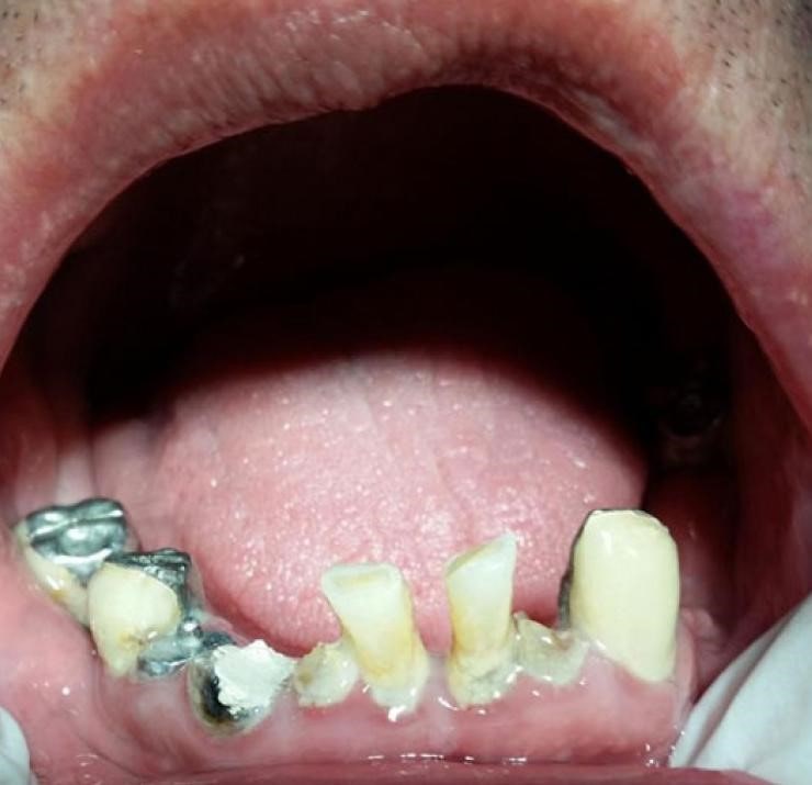 گزینه های مدیریت و درمان برای از دست دادن دندان