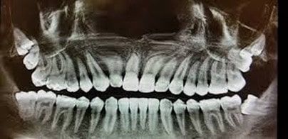 پیامدهای داشتن 8 دندان عقل