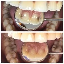 علائم پوسیدگی دندان در مقابل لکه های بی ضرر