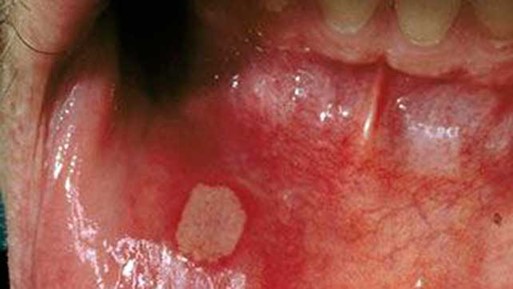 انواع استوماتیت: چگونه آنها را از یکدیگر تشخیص دهیم و چگونه خطرناک هستند؟