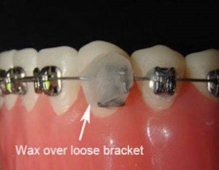 چگونه بریس های شکسته را تعمیر کنیم؟