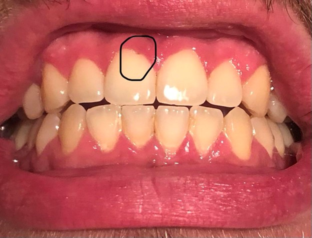 علت ایجاد حفره خط لثه چیست؟