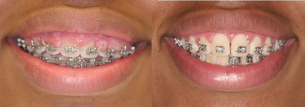 چه زمانی برای لثه های متورم به دندانپزشک مراجعه کنید؟