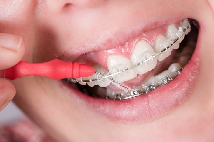 چگونه با بریس ها از شر بوی بد دهان خلاص شویم؟