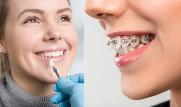 چه زمانی بریس ها یا الاینرهای شفاف ممکن است انتخاب بهتری باشند؟