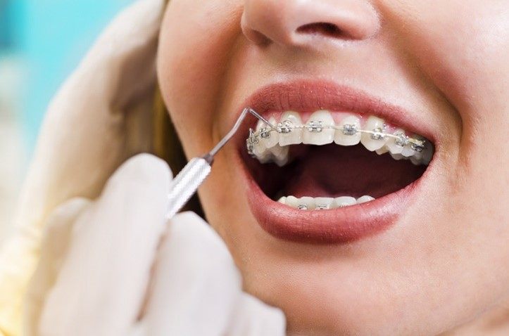 چه نشانه هایی حاکی از این هستند که بریس های من کار می کنند؟