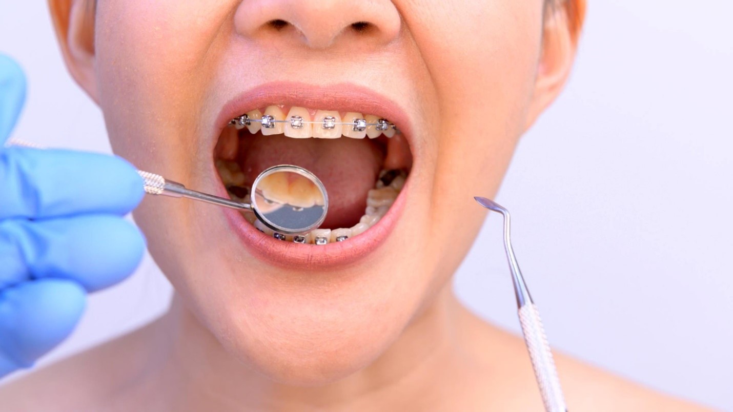 اگر حفره داشته باشید و از بریس ها استفاده کنید، چه می شود؟