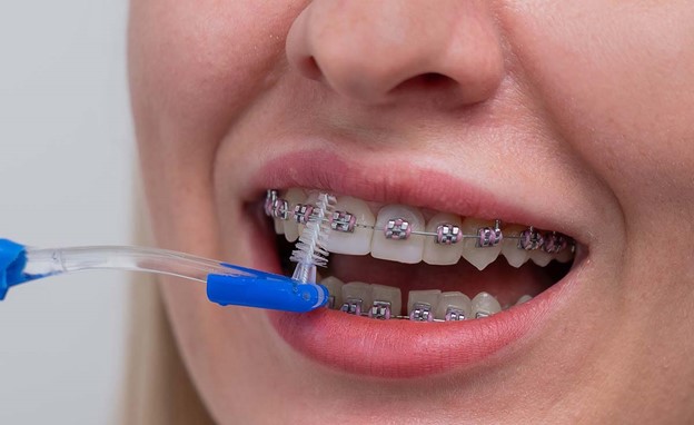 چگونه با وجود بریس ها، پوسیدگی دندان را مدیریت کنیم؟