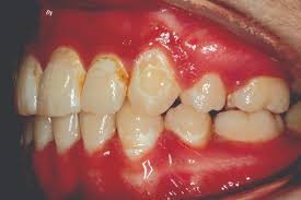 درمان های تخصصی برای بازسازی مینای دندان ها