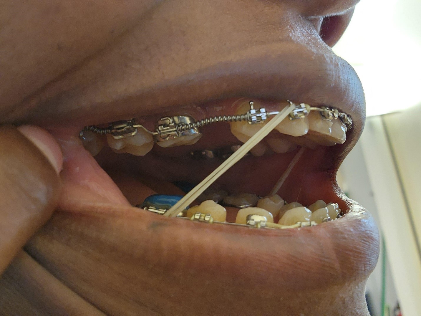 چرا ممکن است افراد دندان های خود را از دست بدهند؟