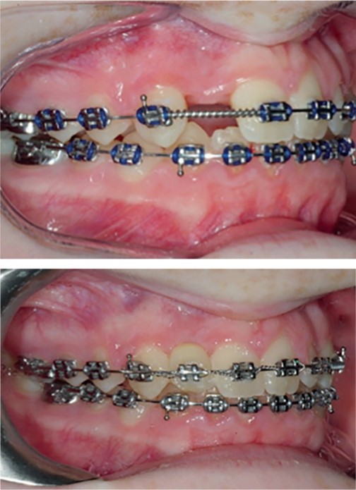 آیا نوجوانان می توانند با وجود دندان های از دست رفته، ارتودنسی کنند؟