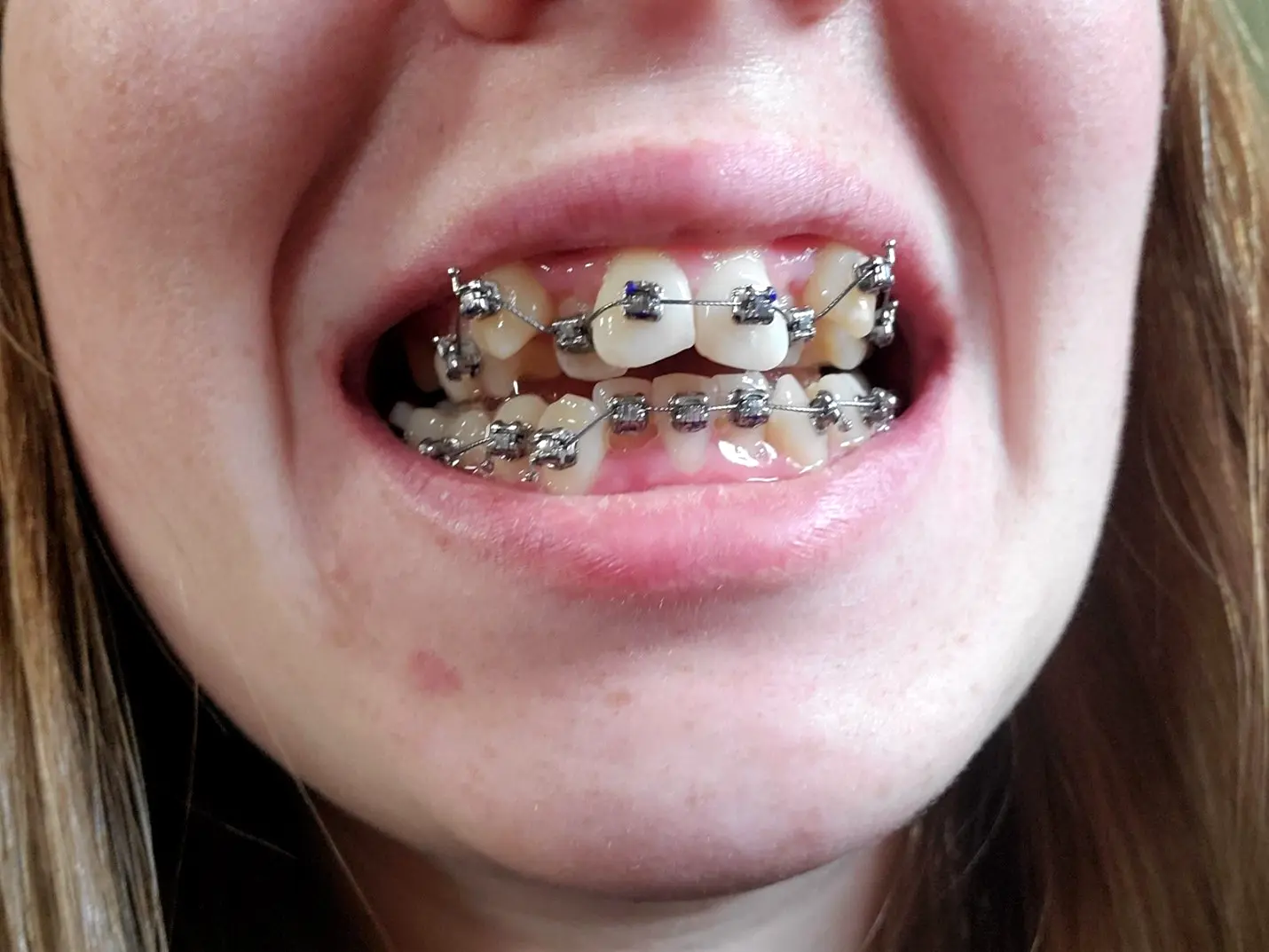 یک دندان با بریس ها چه مدت درد می کند؟