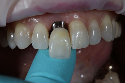 مزایای روکش های دندانی یک روزه